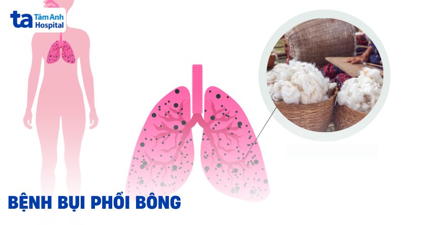 benh bui phoi bong