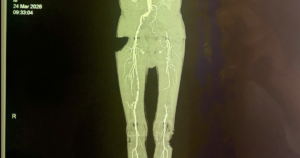 Loét gót chân kéo dài, bệnh nhân suýt phải cưa chân 2 cua chan tac mach chi 2 17756350462631052887983 0 0 1530 2448 crop 17756352466421420864552