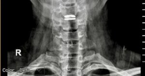 dau co vai gay 17738139155801575375124 86 0 448 579 crop 17738139246231884173052