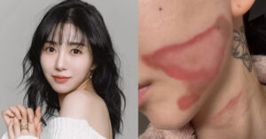 Guong Mat Nu Ca Si 33 Tuoi Bi Bong Nghiem Trong Sau Tham My 14