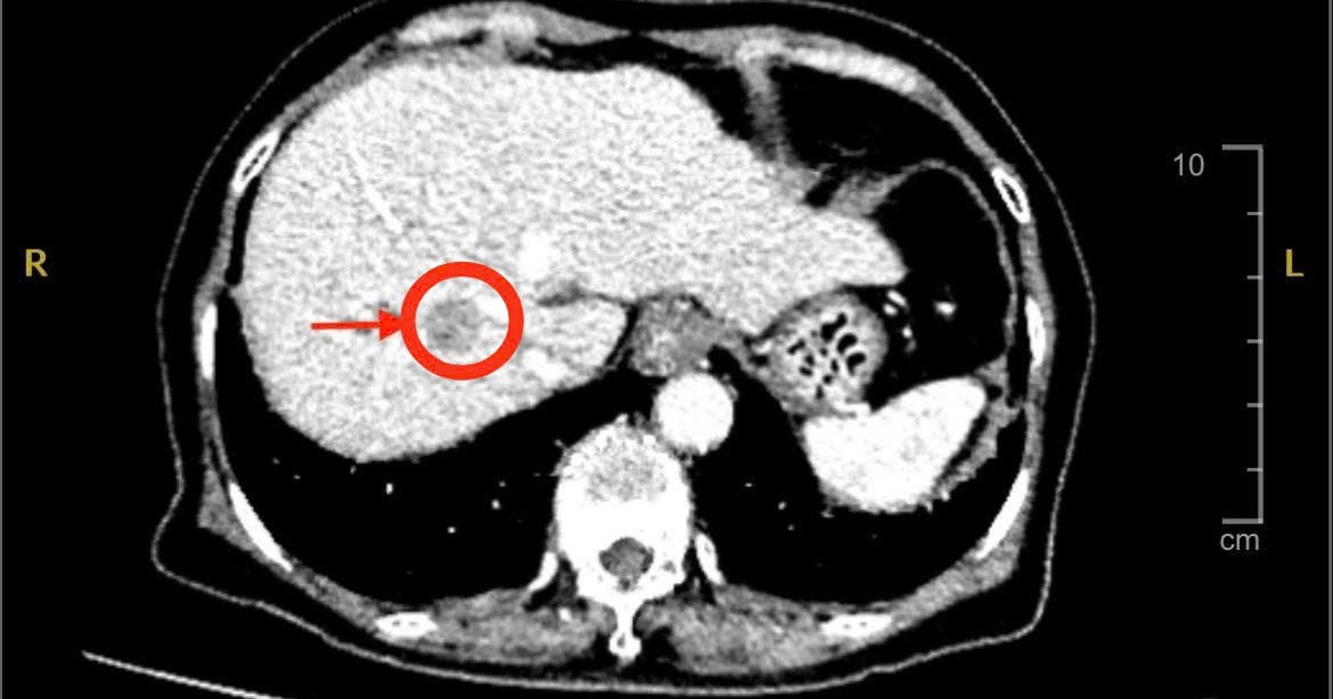 Hinh Anh Ct Khoi U Gan 1762604011582569754553 93 0 824 1170 Crop 17626040273321937407238