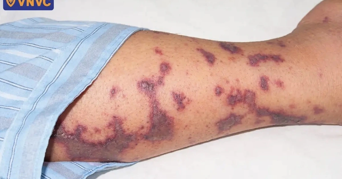 nao mo cau xuat huyet da 17760553060201826861432 0 0 711 1138 crop 1776055310014788020308