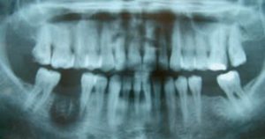 Thạch Tín Diệt Tủy Răng Trong Nha Khoa Gây Hoại Tử Xương, Mô, Quá Nhiều Độc Tính Nha Khoa 1 1769671020175960262903 9 0 229 352 Crop 17696710237971475650976