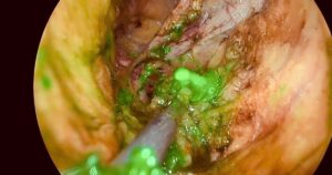 Lần Đầu Tiên Việt Nam Ứng Dụng Kỹ Thuật Mới Điều Trị Ung Thư Phụ Khoa Noi Soi 1768447041272571399397 0 0 720 1152 Crop 1768447046275907403515