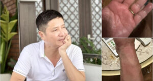 nsut chi trung mac benh la mat ngu trien mien 1199