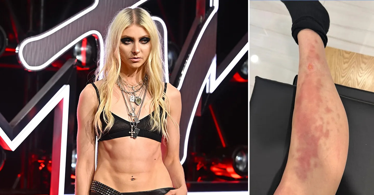 nu ca si 33 tuoi nhap vien cap cuu vi bi nhen doc can 2391.webp