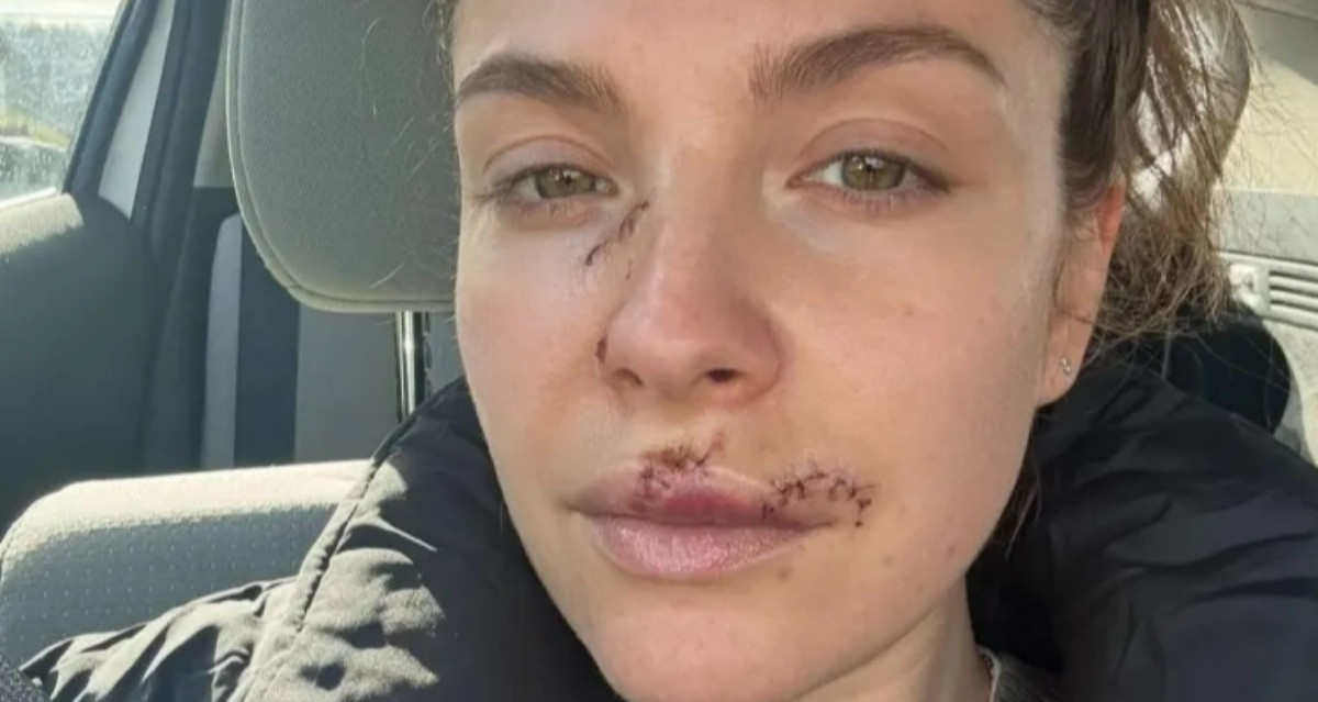 Nu Dien Vien 37 Tuoi Lo Guong Mat Day Vet Thuong Sau Vu Bi Cho Can 536.Webp