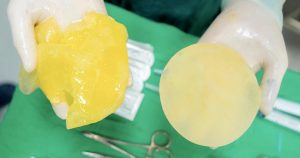 Túi Nâng Ngực Có Dễ Vỡ Khi Chơi Thể Thao? Photo 1769513327770 1769513329415269160709 0 0 938 1500 Crop 1769513344108892253264