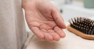 Chuyên Gia: Muốn Giảm Rụng Tóc, Hãy Chú Ý Những Điều Sau Đây! Rung Toc 17701666712831512480345 52 0 692 1024 Crop 1770166958175162607538