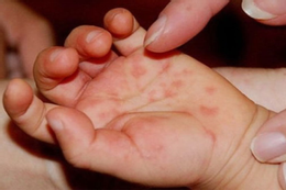 so ca tay chan mieng tang gap 5 lan 4 tre tu vong bo y te chi dao khan 747 1