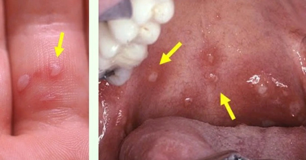 thumb 1dau hieu 1775330086647422824906 1775330096627547724550 199 574 624 1254 crop 1775347655279147