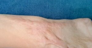 Trẻ 4 tuổi bị bỏng nặng do ngã vào nồi nước sôi 1 tre em bong nuoc soi 17719007682141083437395 15 0 223 333 crop 17719007736031658043791