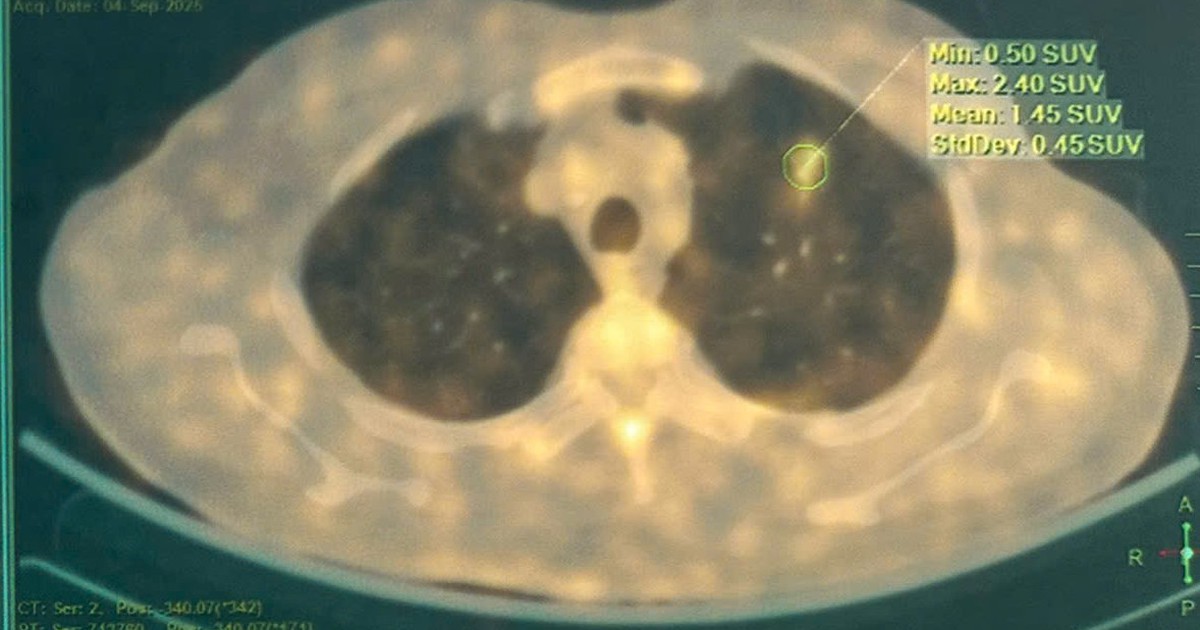 ung thu 1774505645786988085956 0 0 736 1178 crop 17745056499241188223377