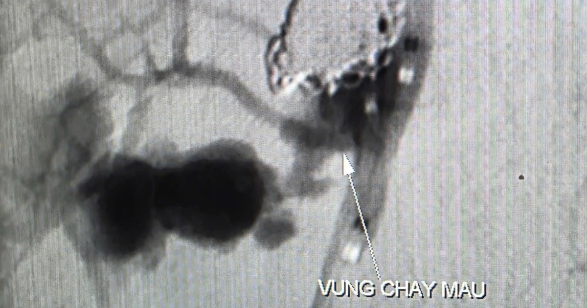 Ung Thu Chay Mau 1 1772768323901450078391 67 0 1541 2359 Crop 17727688565481366142902 336 0 1165 132