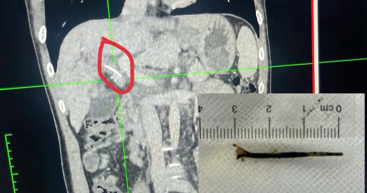 ung thu hoc xuong ca di vat 2 1774514506386785848026 32 0 625 949 crop 1774520173107754015456