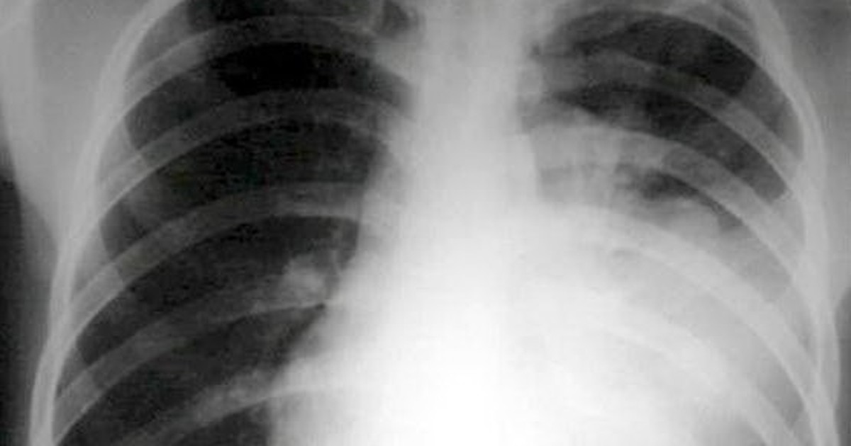 Viem Phoi Bm 1763040328758238803802 24 0 372 556 Crop 1763040339054603642966